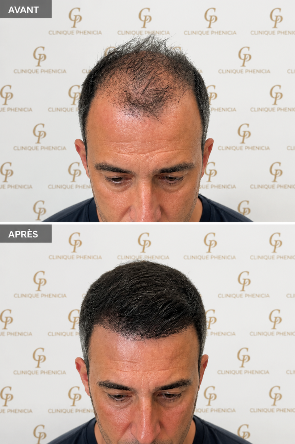 Avant / après greffe capillaire — couverture du vertex et restauration de la densité capillaire